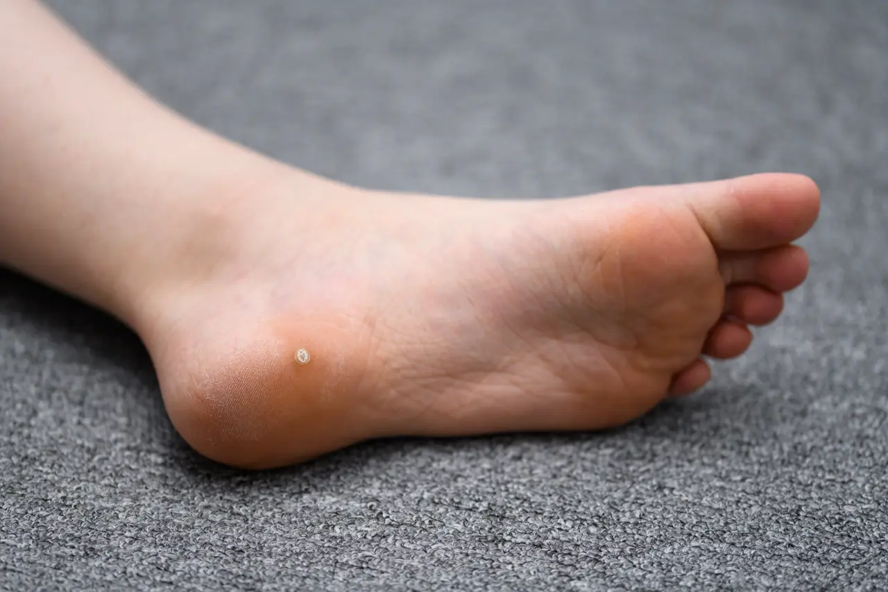 Recette contre les verrues plantaires avec des huiles essentielles