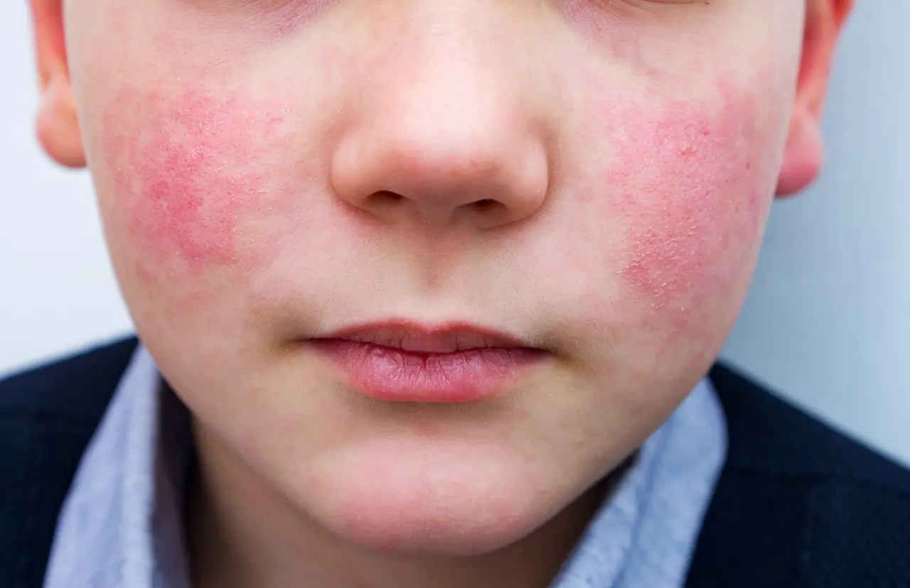 Apaiser les rougeurs et la couperose avec les huiles essentielles