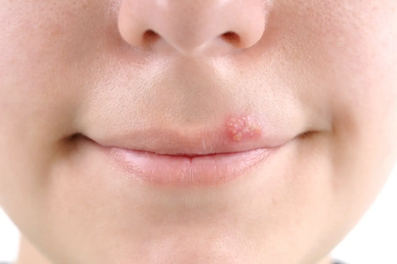 Soigner un bouton de fièvre à l’aide des huiles essentielles