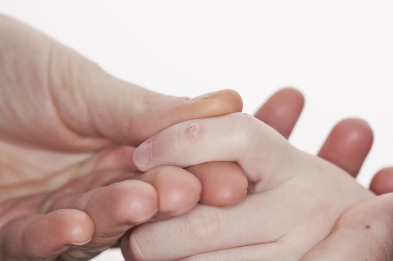 Soigner les verrues de l'enfant ou de l'adulte avec les huiles essentielles
