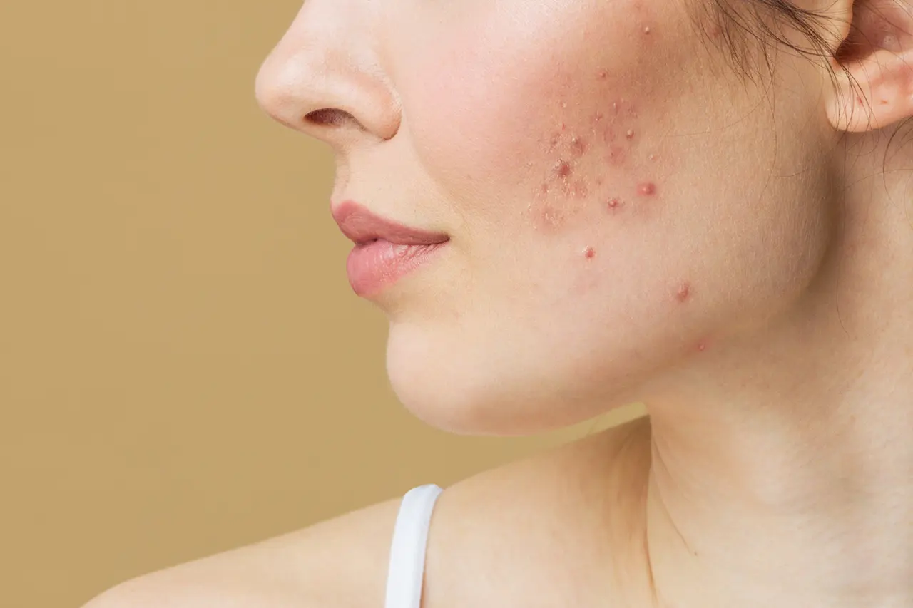 Traiter l'acné et les problèmes de peau avec des huiles essentielles