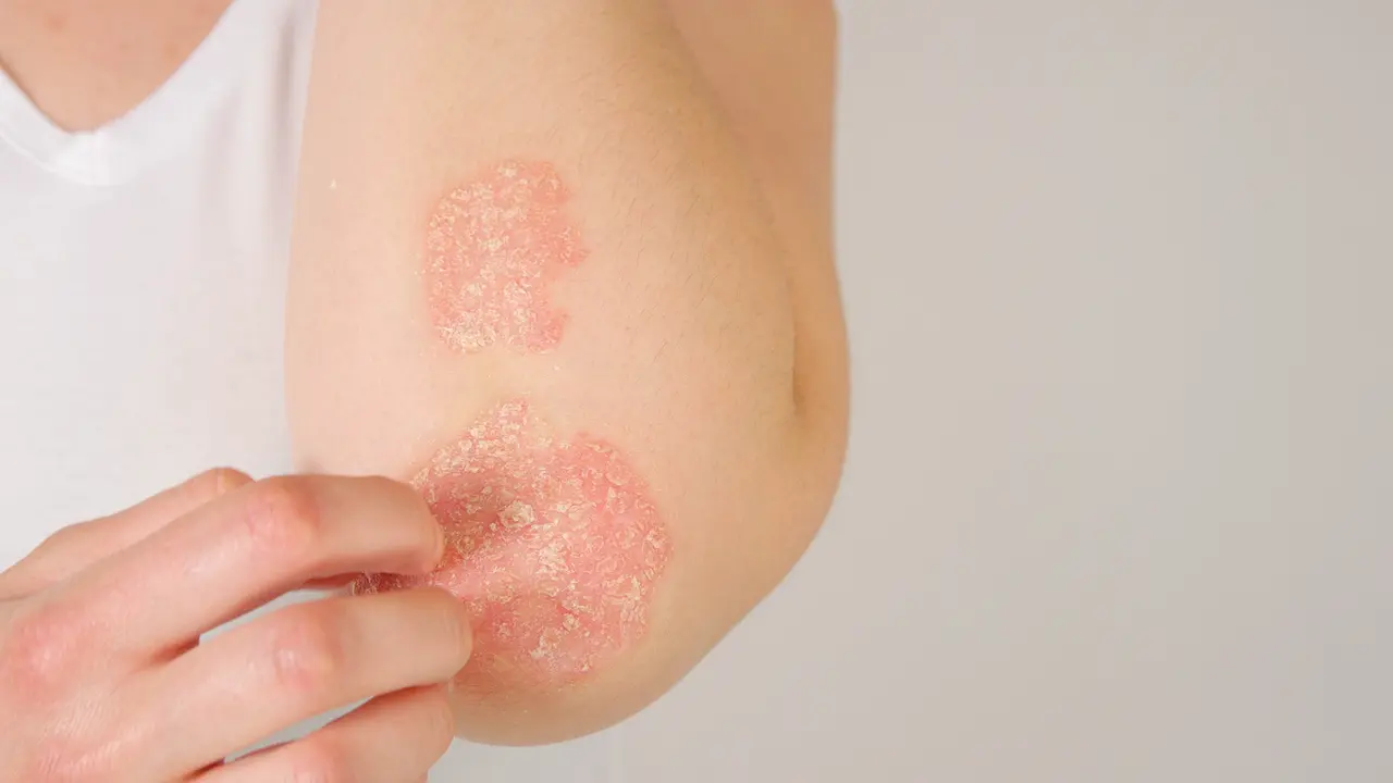 Les huiles essentielles pour lutter contre le psoriasis