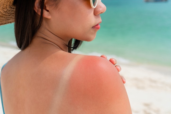 Apaiser un coup de soleil naturellement